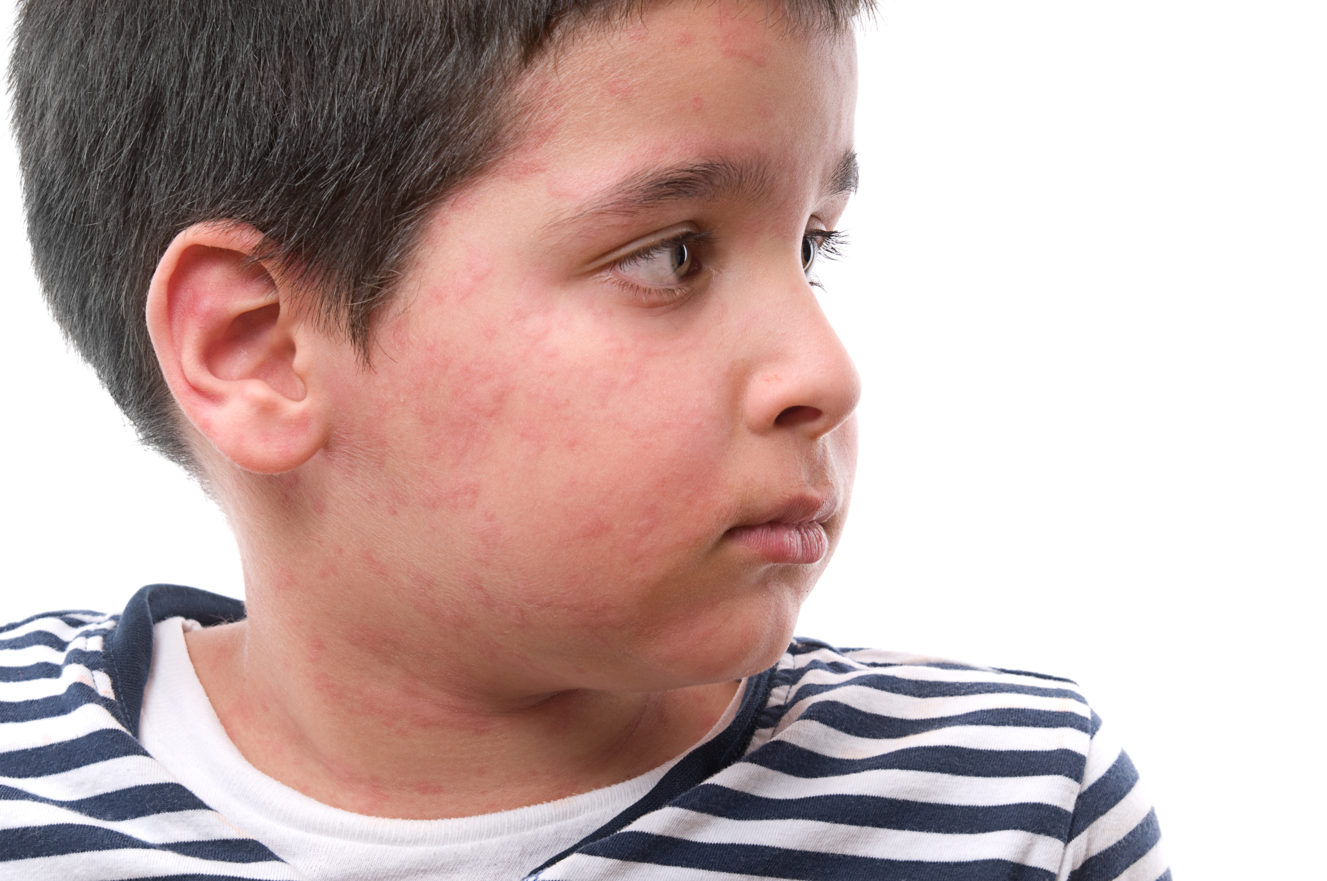 Аллергия у детей отек квинке крапивница thumbnail